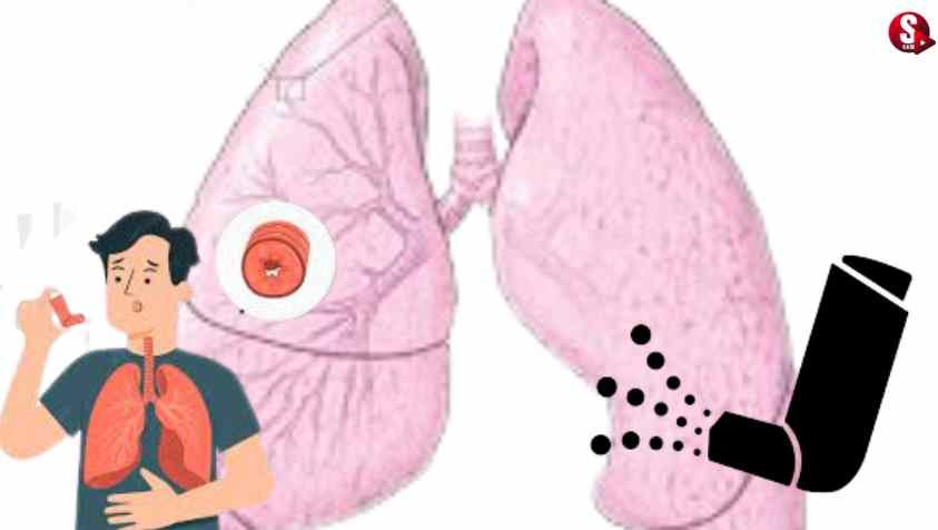 ஆஸ்துமாவை எவ்வாறு கண்டறிவது....? சிகிச்சைகள் என்னென்ன? | Asthma Diagnose in Tamil